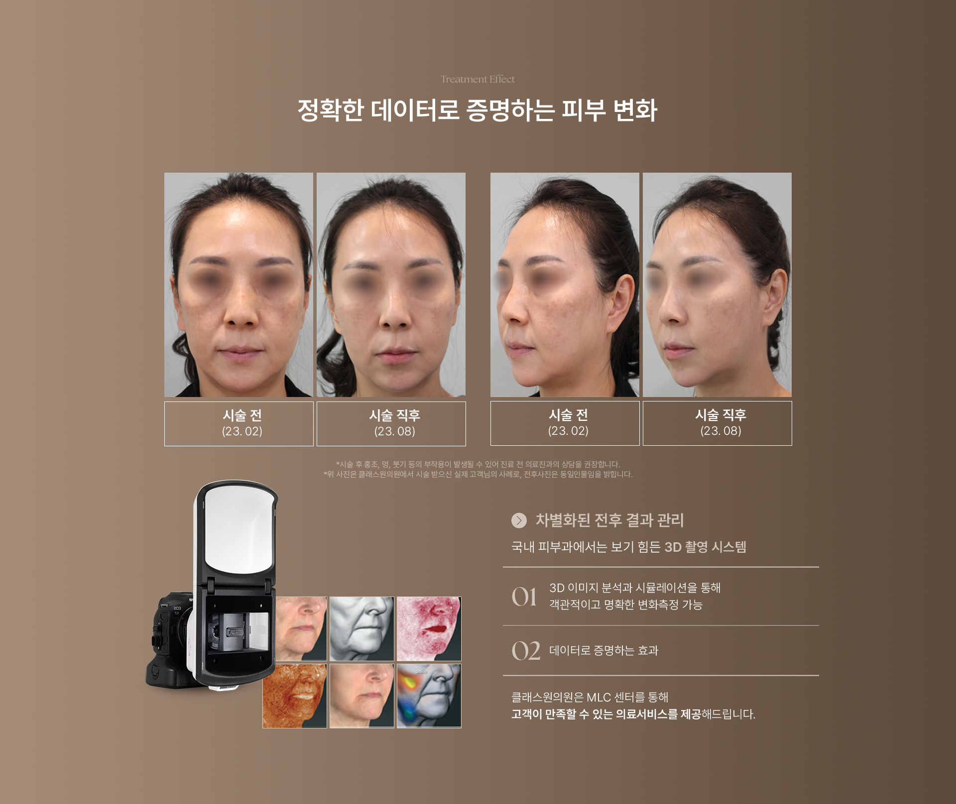 Treatment Effect. 정확한 데이터로 증명하는 피부 변화. 시술전후 첫번째 케이스는 시술 전(23.02), 시술직후(23.08) 비교 이미지 입니다. 시술전후 두번째 케이스는 시술 전(23.02), 시술직후(23.08) 비교 이미지 입니다. *시술 후 홍조,멍,붓기 등의 부작용이 발생될 수 있어 진료 전 의료진과의 상담을 권장합니다. *위 사진은 클래스원의원에서 시술 받으신 실제 고객님의 사례로, 전후사진은 동일인물임을 밝힙니다. 차별화된 전후 결과 관리. 국내 피부과에서는 보기 힘든 3D 촬영 시스템. 01) 3D 이미지 분석과 시뮬레이션을 통해 객관적이고 명확한 변화측정 가능. 02) 데이터로 증명하는 효과. 클래스원의원은 MLC 센터를 통해 고객이 만족할 수 있는 의료서비스를 제공해드립니다.